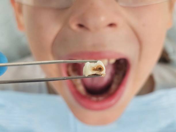 Best Knocked-Out Tooth (Avulsed Tooth) Treatment in Scotts Valley, CA